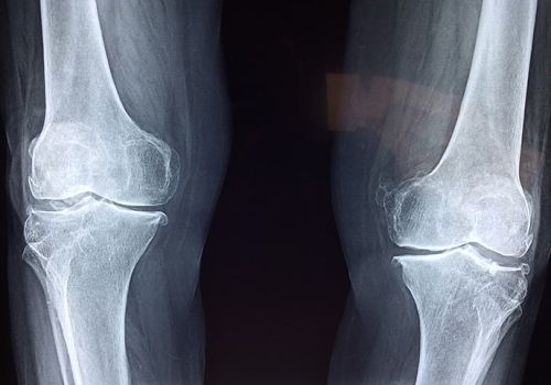 Rarefazione del tessuto osseo conosciuta come Osteoporosi